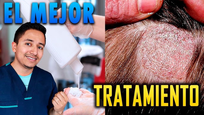 hongos capilares tratamientos